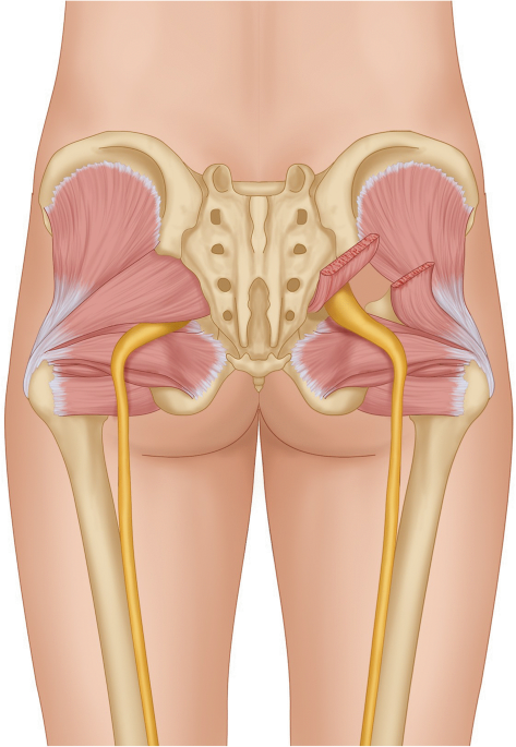 The Piriformis syndrome causes and diagnosis - Everything You Need