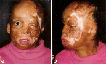 Aesthetic reconstruction of the severely disfigured burned face: a creative  strategy for a “natural” appearance using pre-patterned autogenous free  flaps | Burns & Trauma | Full Text