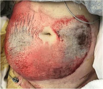 A rare case of severe third degree friction burns and large Morel-Lavallee  lesion of the abdominal wall, Burns & Trauma