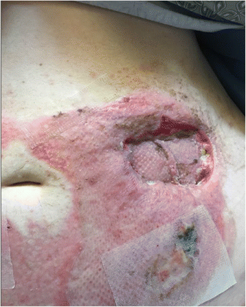 A rare case of severe third degree friction burns and large Morel-Lavallee  lesion of the abdominal wall, Burns & Trauma