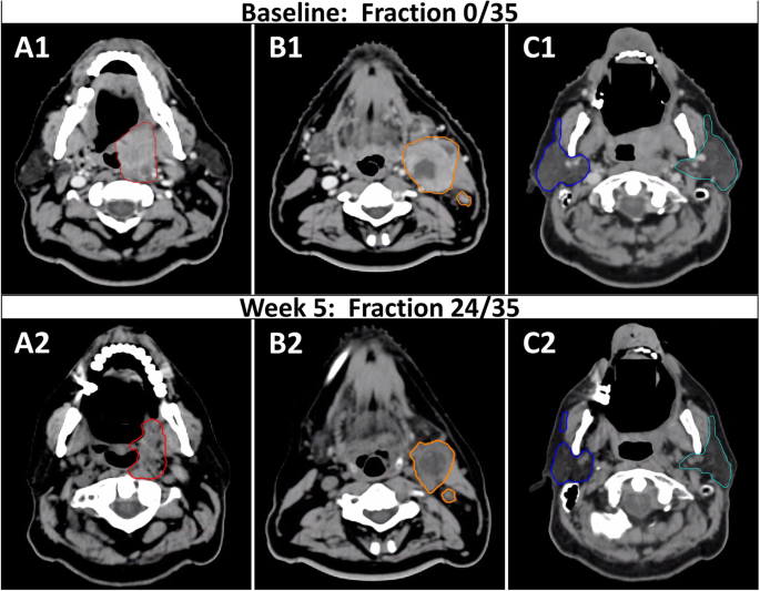 Adaptive radiotherapy for head and neck cancer, Cancers of the Head & Neck