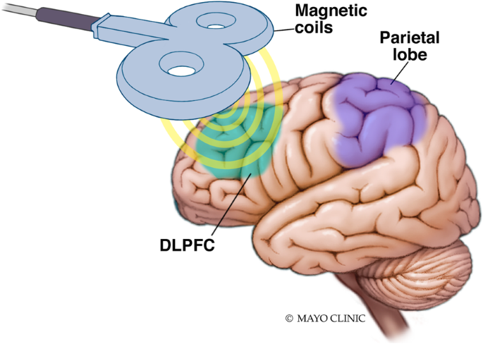Transcranial magnetic stimulation therapeutic applications on sleep and  insomnia: a review | Sleep Science and Practice | Full Text