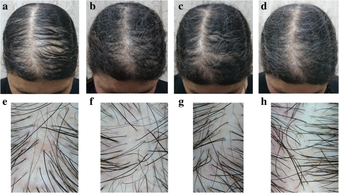 Trichogenic effect of topical ketoconazole versus minoxidil 2% in female  pattern hair loss: a clinical and trichoscopic evaluation | Biomedical  Dermatology | Full Text