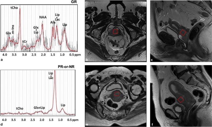 mri glutathione level tumor The contribution of the 1H-MRS lipid signal to cervical cancer prognosis: a preliminary study | European Radiology Experimental Gout is a form KEIFEITB500 Option:Glutathione
