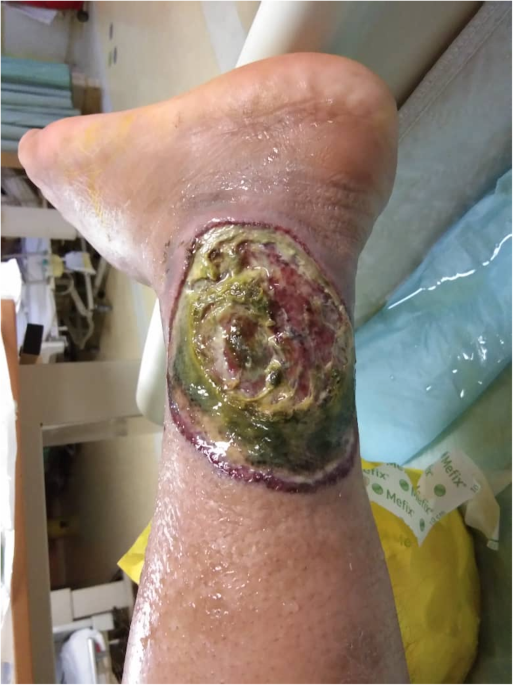 Pyoderma gangrenosum and cobalamin deficiency in systemic lupus  erythematosus: a rare but non fortuitous association | BMC Rheumatology |  Springer Nature Link