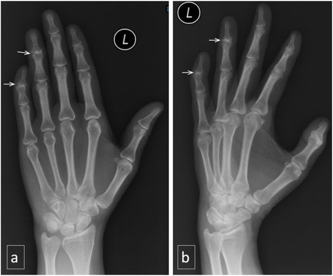 More than meets the naked eye: an unusual psoriatic arthritis mimicry and  the important role of dermoscopic examination | BMC Rheumatology | Full Text