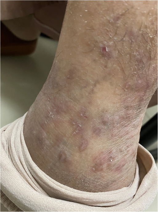 More than meets the naked eye: an unusual psoriatic arthritis mimicry and  the important role of dermoscopic examination, BMC Rheumatology