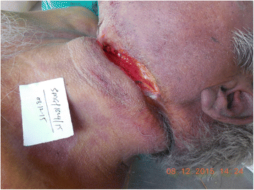 Sub-occipital ligature knot in a case of long drop suicidal hanging with  rare autopsy finding of cervical spine fracture | Egyptian Journal of  Forensic Sciences | Full Text