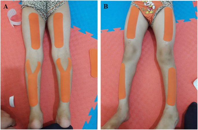 Comparison of the effects of Kinesio tape and neuromuscular electrical  stimulation on hand extensors in children with cerebral palsy