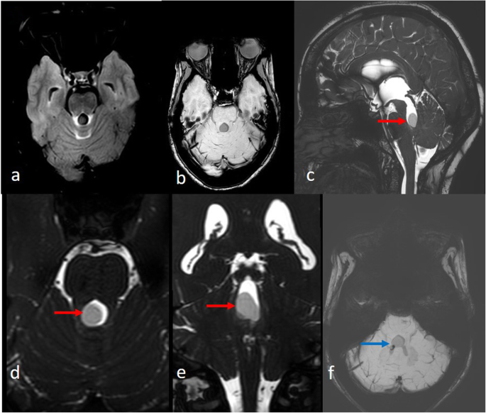 fourth ventricle mri