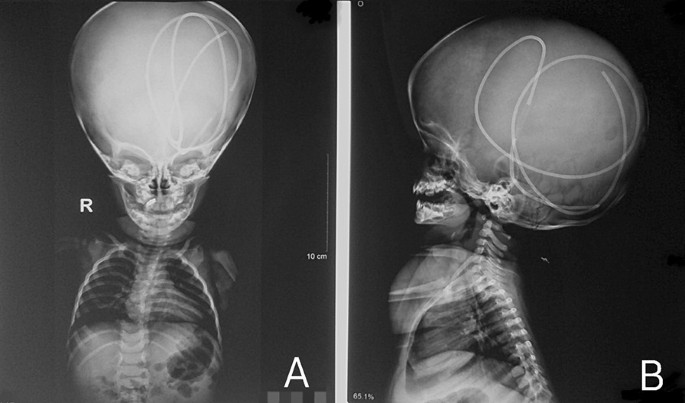 Complete intracranial migration of ventriculoperitoneal shunt: a common  procedure with a rare complication, Egyptian Journal of Neurosurgery
