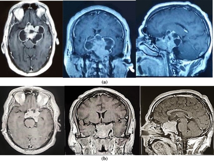 Frontiers  Outcome of giant pituitary tumors requiring surgery