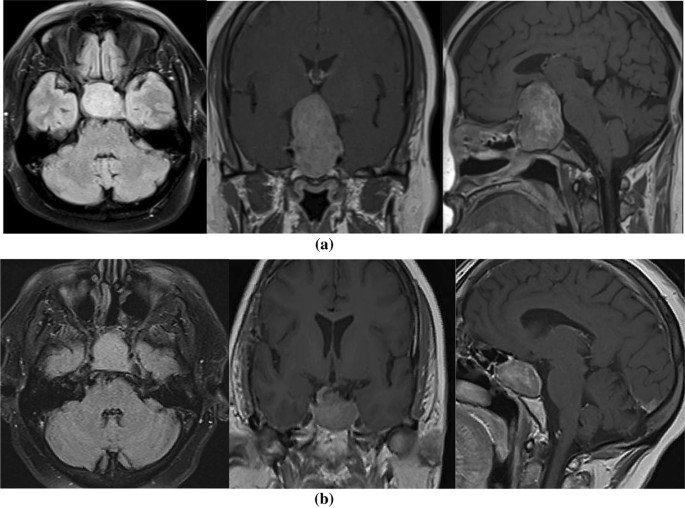 Frontiers  Outcome of giant pituitary tumors requiring surgery