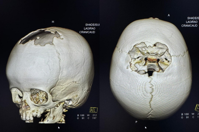 melanotic tumor Melanotic neuroectodermal tumor of infancy: extra-axial lesion in the  frontal midline of the skull – a case report | Surgical and Experimental  Pathology