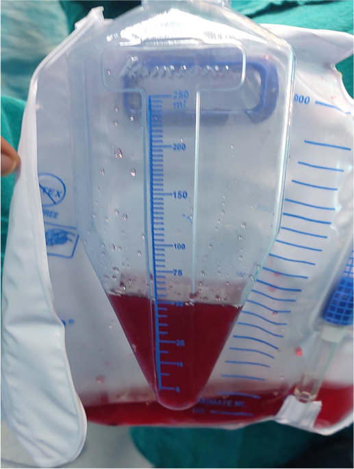 Intra-operative pinkish-red discoloration of urine: rule out anesthetic  drug as a cause | Ain-Shams Journal of Anesthesiology