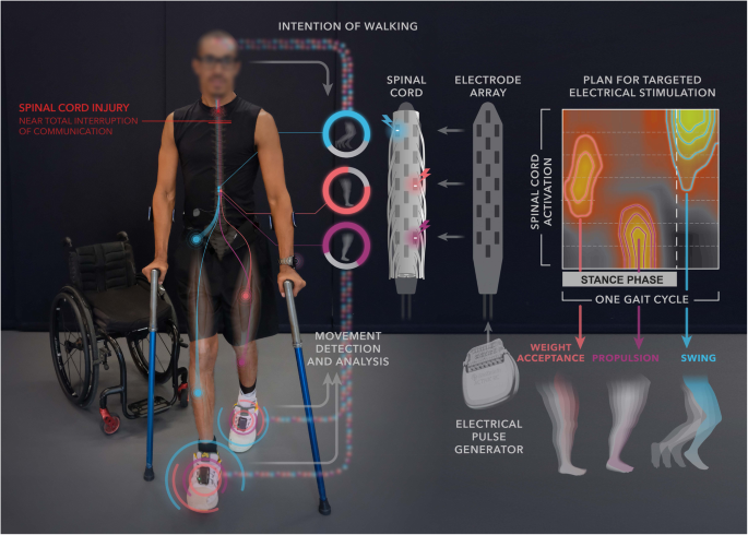 Electrical Stimulation for Spinal Cord Injury: How It Works