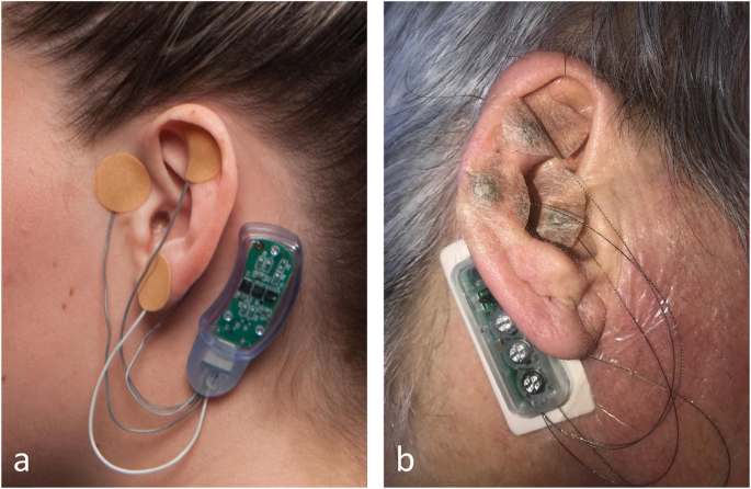 5 Best E-Stimulation Devices for Pain and Nerve Regeneration - Modern  Neuropathy