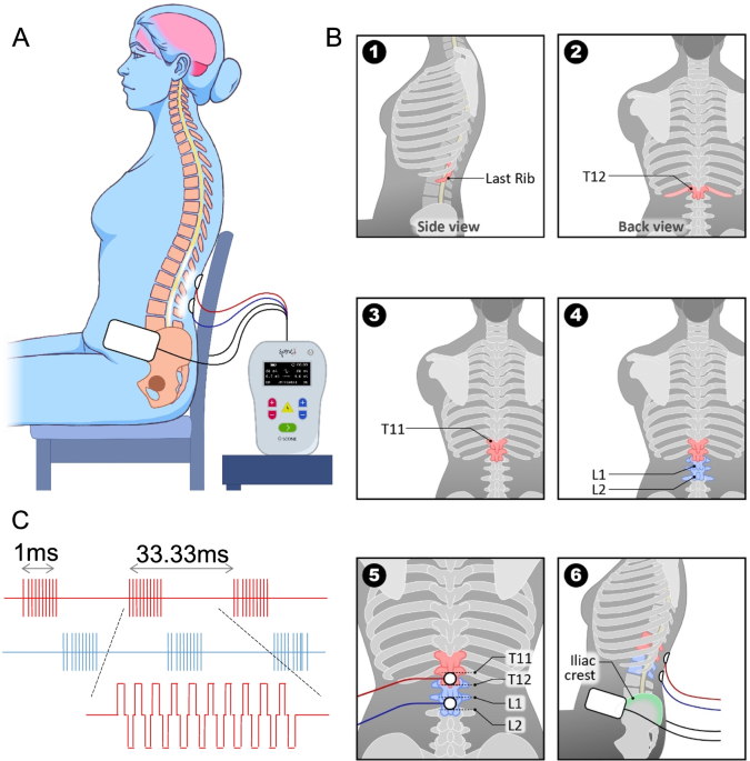 Noninvasive spinal neuromodulation mitigates symptoms of idiopathic  overactive bladder, Bioelectronic Medicine