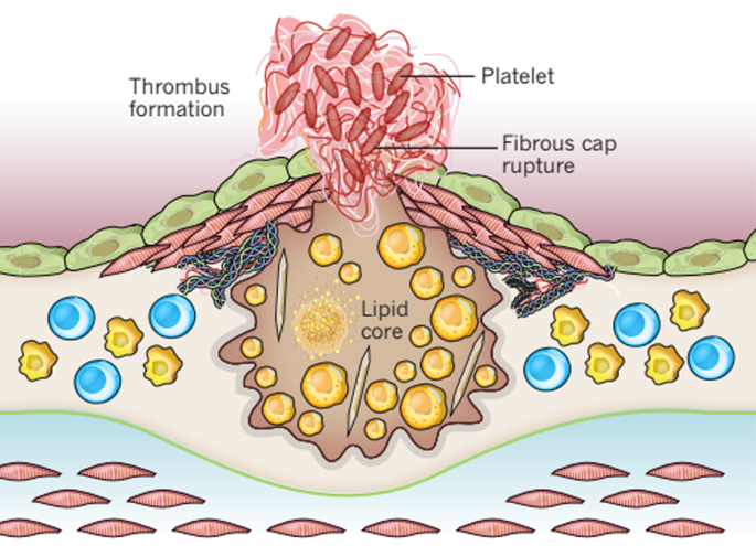 A Definition of Advanced Types of Atherosclerotic Lesions and a  Histological Classification of Atherosclerosis