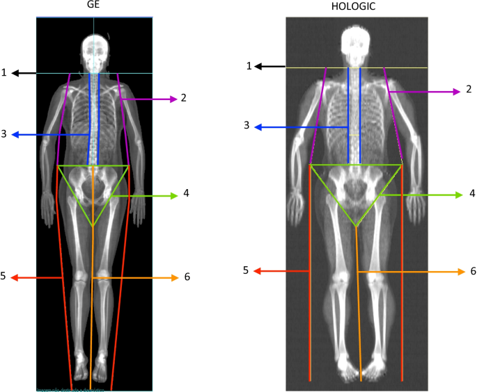 DEXA scan Albuquerque - Bone Densitometry, Bone Density Scan