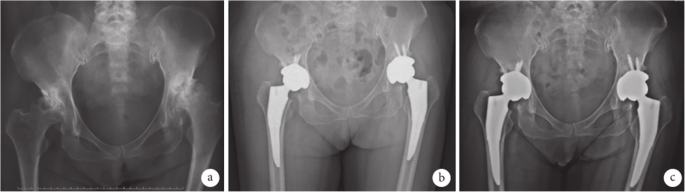 Is the 'Anterior Approach' Total Hip Replacement Better? - Tri-City  Orthopaedic Clinic