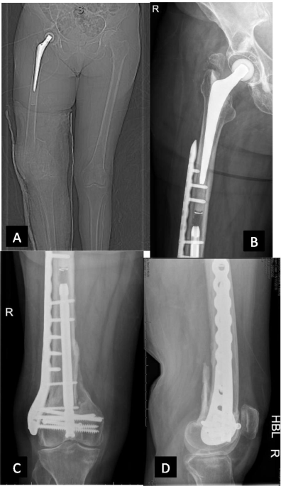 Comparison of Clinical Efficacy of Lateral and Lateral and Medial  Double-plating Fixation of Distal Femoral Fractures | Scientific Reports