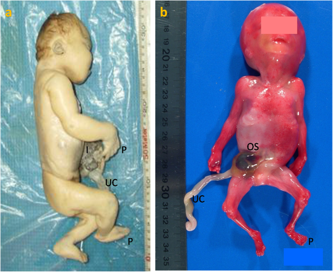 Omphalocele as component of multiple anomaly syndrome/sequence