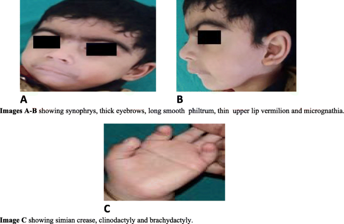 First case report of inherited Rubinstein-Taybi syndrome