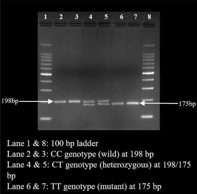 MTHFR (C677T) polymorphism and its association with cytogenetic and clinical profile in individuals with primary amenorrhea | Egyptian Journal of Medical Human Genetics