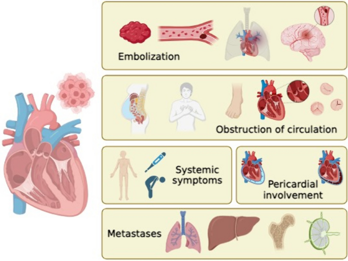 melanotic sarcoma of heart Survival outcomes in patients with primary cardiac in the United States Primary Cardiac Synovial Sarcoma