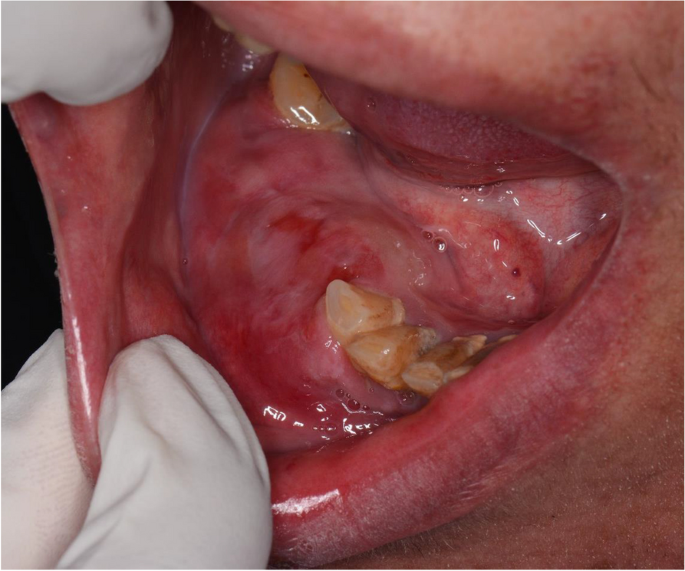 Clinical photograph showing the swelling in the mandibu