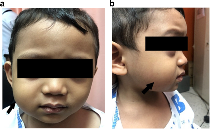 Parotid sialolithiasis and sialadenitis in a 3-year-old child: a case  report and review of the literature | Egyptian Pediatric Association  Gazette | Full Text