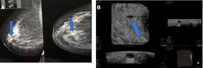 Automated breast ultrasound system (ABUS): can it replace mammography as a  screening tool?, Egyptian Journal of Radiology and Nuclear Medicine