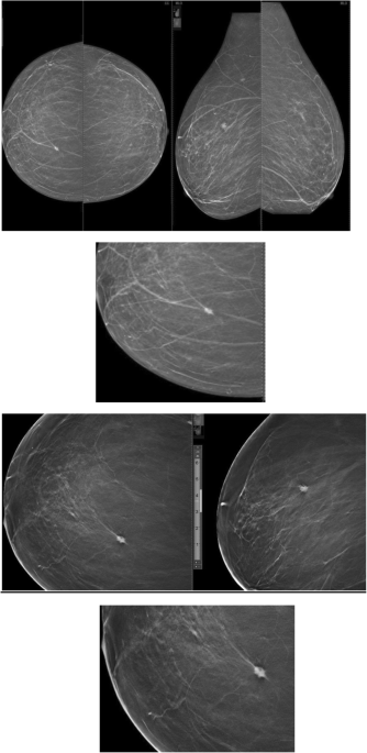 Study of role of digital breast tomosynthesis over digital mammography in  the assessment of BIRADS 3 breast lesions, Egyptian Journal of Radiology  and Nuclear Medicine