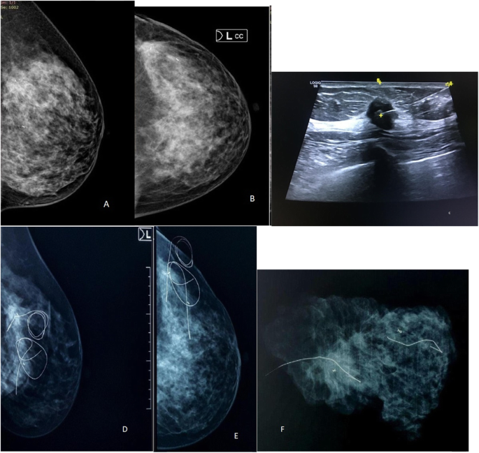 Clip and wire localization of locally advanced malignant breast masses in  patients undergoing neoadjuvant chemotherapy and breast conservation  therapy, Egyptian Journal of Radiology and Nuclear Medicine