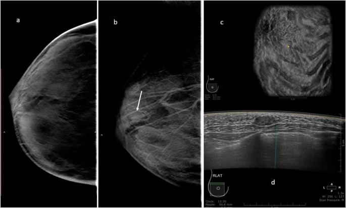 Breast ultrasonography revealed a 36-mm irregular mass at the 9 o'clock