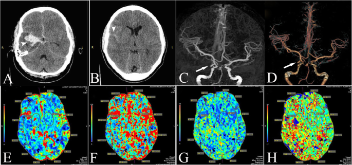 Frontiers  Delayed Cerebral Ischemia After Subarachnoid