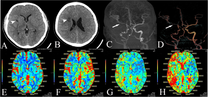 Subarachnoid Hemorrhage (SAH) - Trial Exhibits Inc.