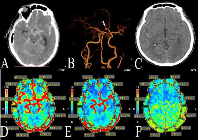 Subarachnoid Hemorrhage (SAH) - Trial Exhibits Inc.