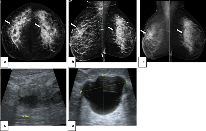 3D digital breast tomosynthesis versus US in evaluating breast asymmetries, Egyptian Journal of Radiology and Nuclear Medicine