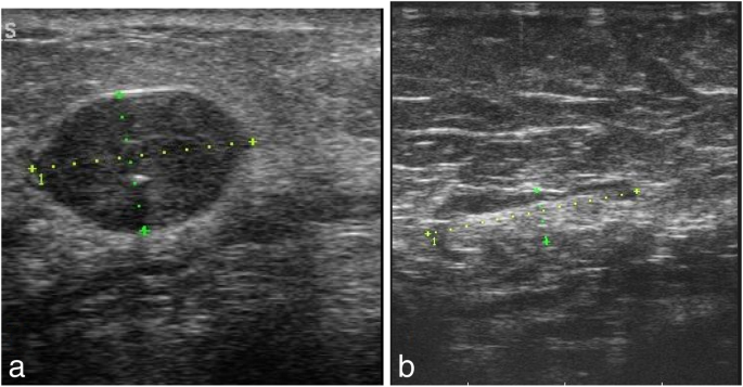 Triple-negative invasive breast carcinoma: the association between