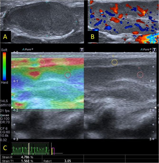 B-mode ultrasound, color Doppler, and sonoelastography in