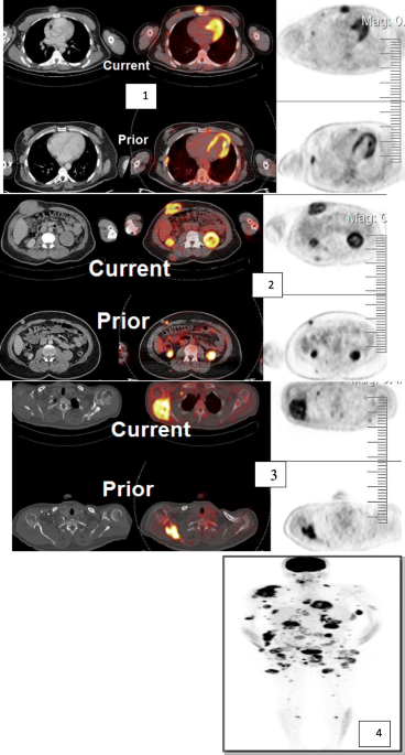 Active surveillance of patients who have sentinel node positive