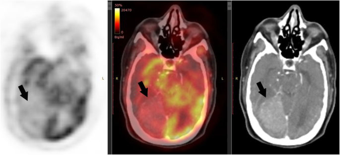 Brain PET scan