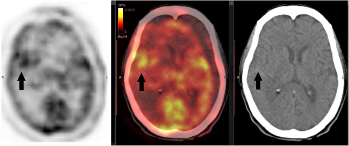 Automated detection of brain metastases on non-enhanced CT using