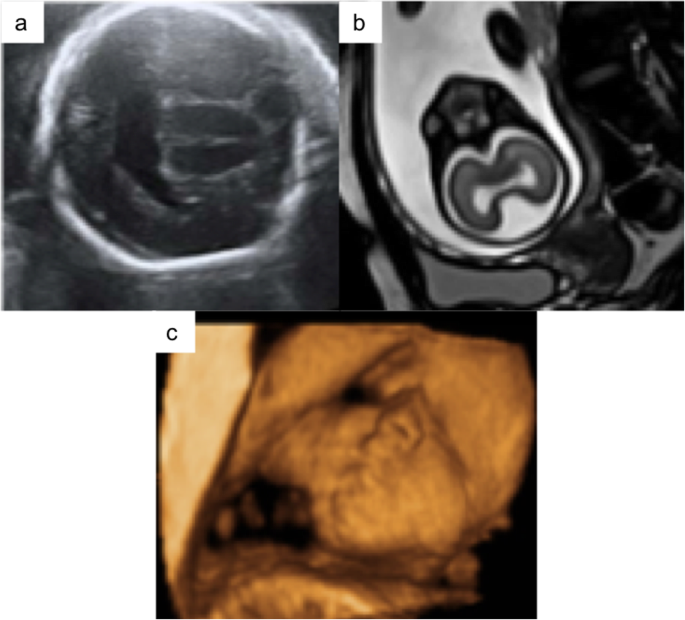 Use of MRI in the diagnosis of fetal brain abnormalities in utero  (MERIDIAN): a multicentre, prospective cohort study - The Lancet