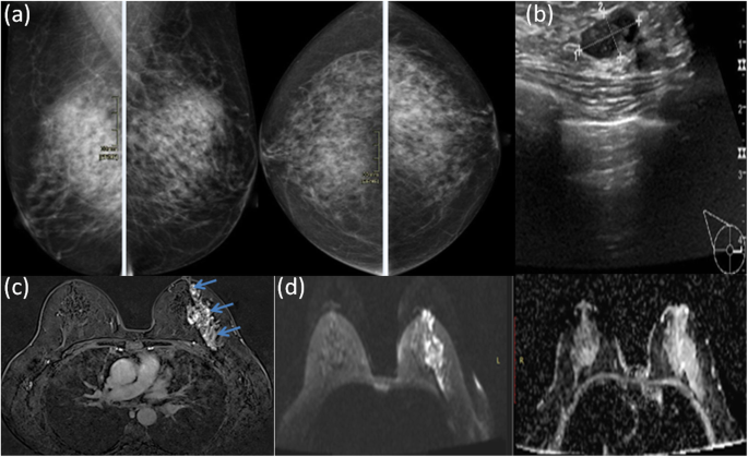 The additive role of dynamic contrast-enhanced and diffusion-weighted MR  imaging in preoperative staging of breast cancer, Egyptian Journal of  Radiology and Nuclear Medicine