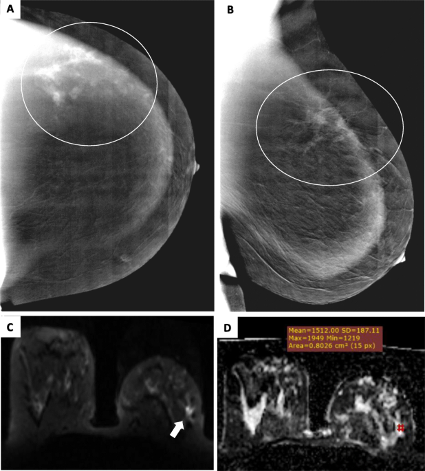Medium-sized dense breast: a representative MR slices; b BCFCM outputs;