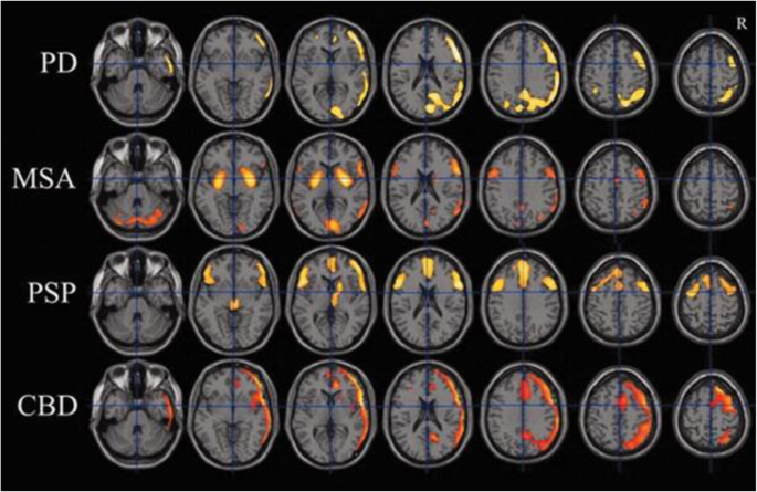 Imaging biomarkers in Parkinson's disease and Parkinsonian