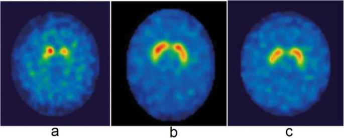 Imaging biomarkers in Parkinson's disease and Parkinsonian